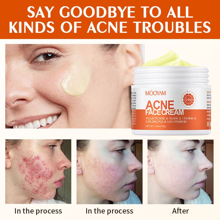 MOOYAM Acne Removal Cream